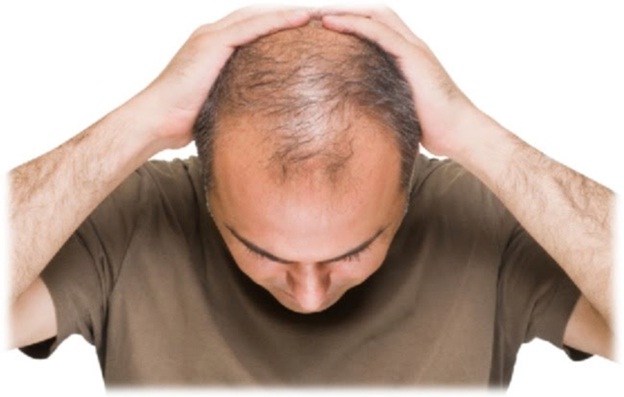 Rụng tóc – Hói đầu ở nam giới chữa thế nào?